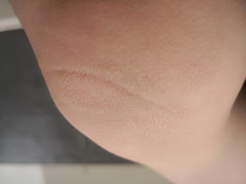 Tanda2 Eczema