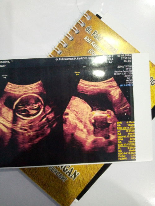 Jk detunn apa ya bund klo hasil usgnya gini? usg di 18 week kemarin