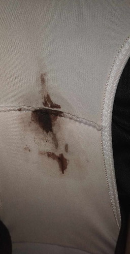 Excuse po.
Implantation bleeding po ba kapag ganito?