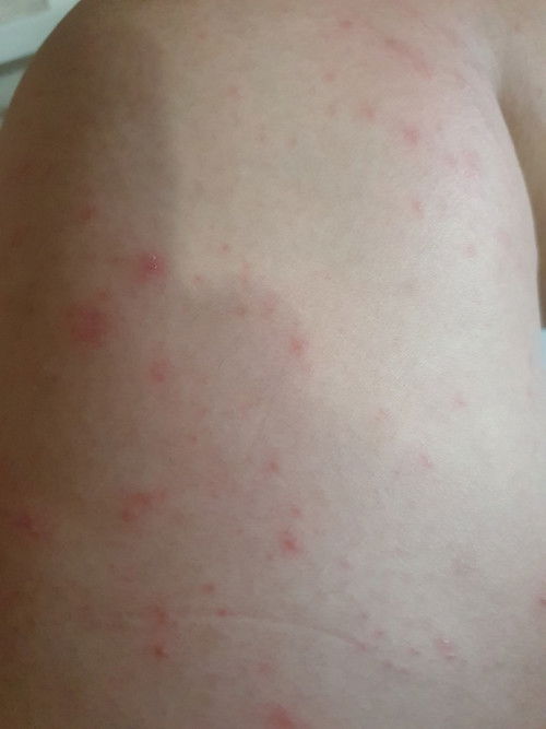 Gatel2 parah di 35-36 week