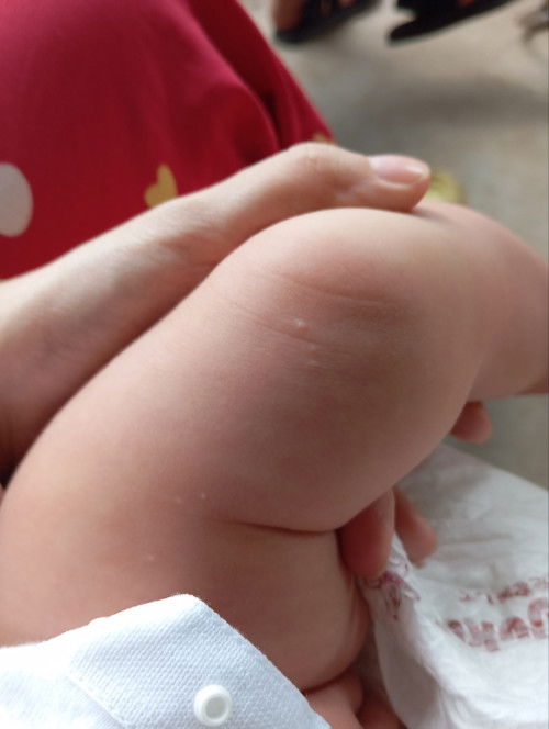 Bé em đc 3 tháng nổi mấy hột này là bị dì v ạ. Cách trị như thế nào v ạ