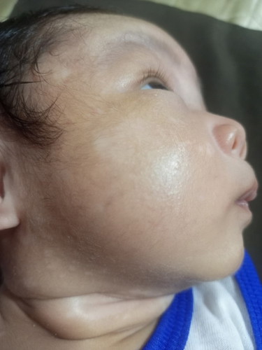 paano po gamutin eto sa mukha at leeg ng anak ko