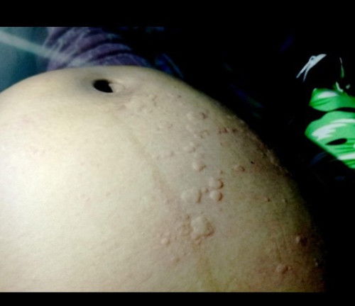 Nangangati at nagpantal na maliliit wala naman po ako allergy?may naka experience din po ba sa inyo?