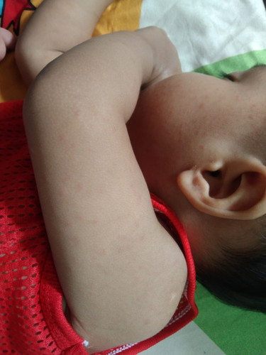 น้องมีผื่นแดงขึ้นตามตัว แขน ขา และ ใบหน้า เป็นเพราะอะไรค่ะ