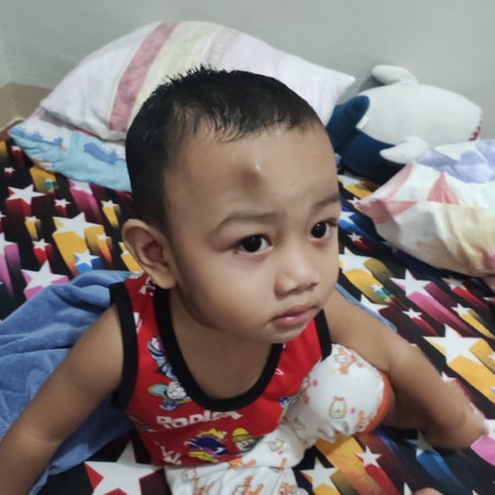 gaano po katagal mawala ang bukol sa noo ng toddler? 8days na kase may bukol padin baby ko. thanks