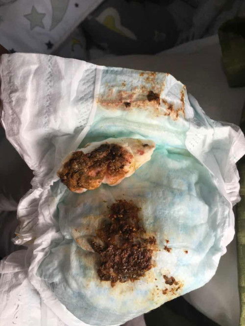 Poops ni baby 3 weeks old