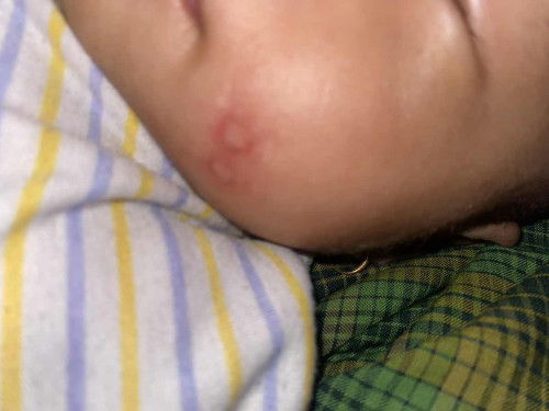 Muka kayak melepuh habis digigit nyamuk