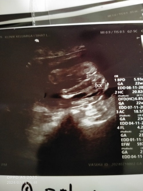 Hi mommy's. Skrg saya 23 minggu 2 hari. Saya scan 22 minggu 5 hari. Doc kata baby girl