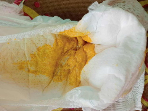 ถ่ายแบบนี้ปกติมั้ยคะ