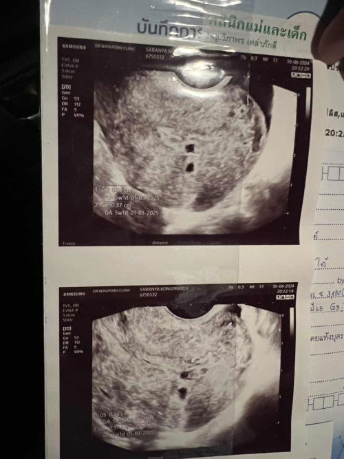 ฝากครรภ์5wเจอถุงครรภ์แฝด