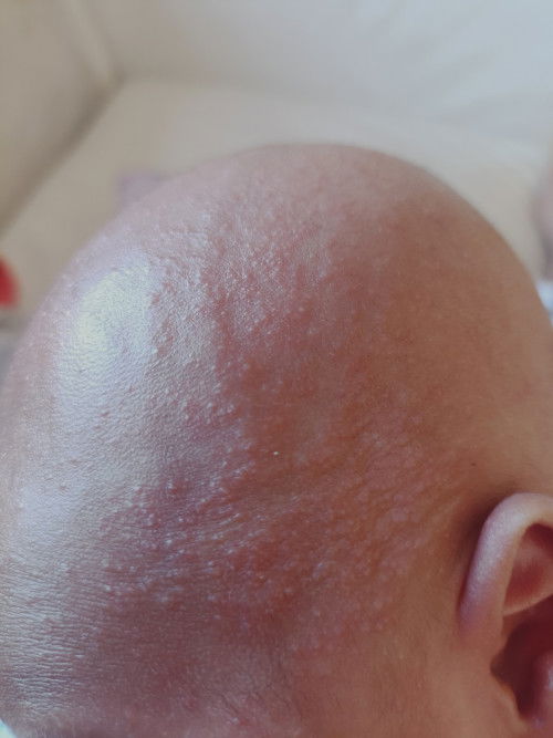 น้องอายุ 1 เดือน 25 วันค่ะ มีผื่นขึ้นตามหัว หน้าและแขน 2ข้าง น้องกินนมผง เปลี่ยนนมแล้ว