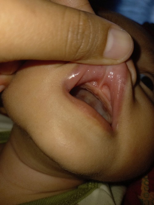 Liptie atau tidak