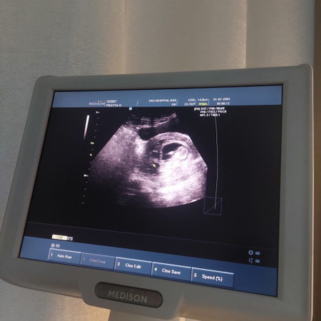 hamil dengan hematome