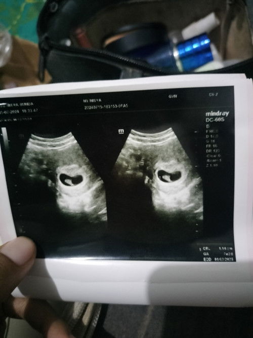 Hasil usg perut Hamil 7W1D setelah sebelumnya divonis BO