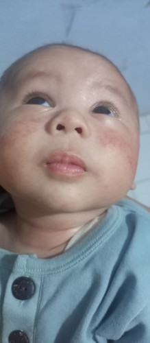 Ruam pipi