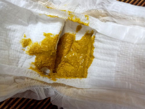 Bé e sinh được 12 ngày. Gần tuần nay bé đi phân hơi lỏng. Có phải bé bị đau bụng k ạ!