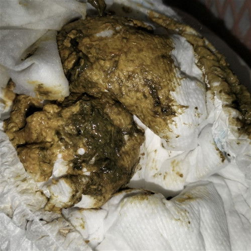 ลูกถ่ายสีดำๆเขียวๆ