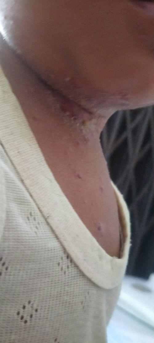 Cacar air pada anak  22 bulan