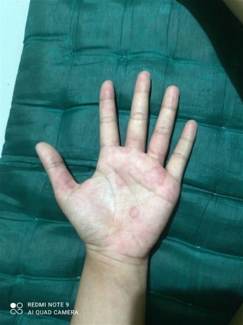 Ada ngga disini yang telapak tangannya gatel digarul jadi begini, kira" Knapa yaa?