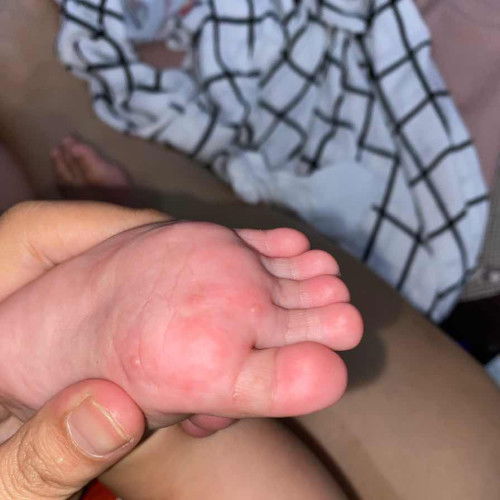 Bintik merah di kaki dan gatel