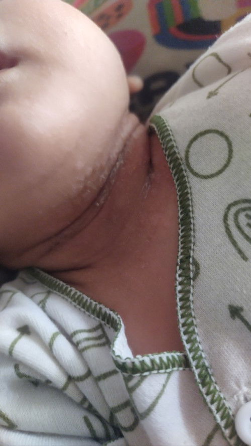 Lecet pada leher bayi