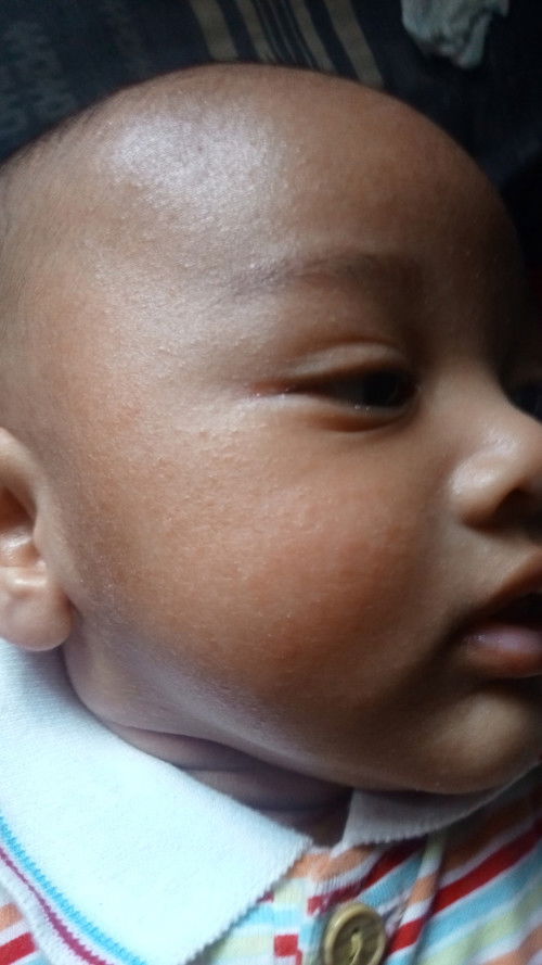 Ruam dan kering diwajah