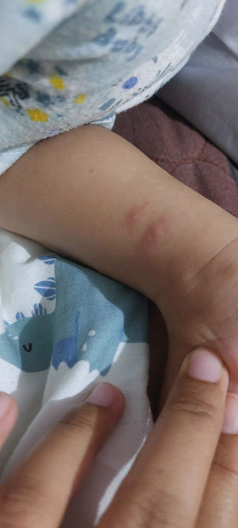 Bentol hilang timbul