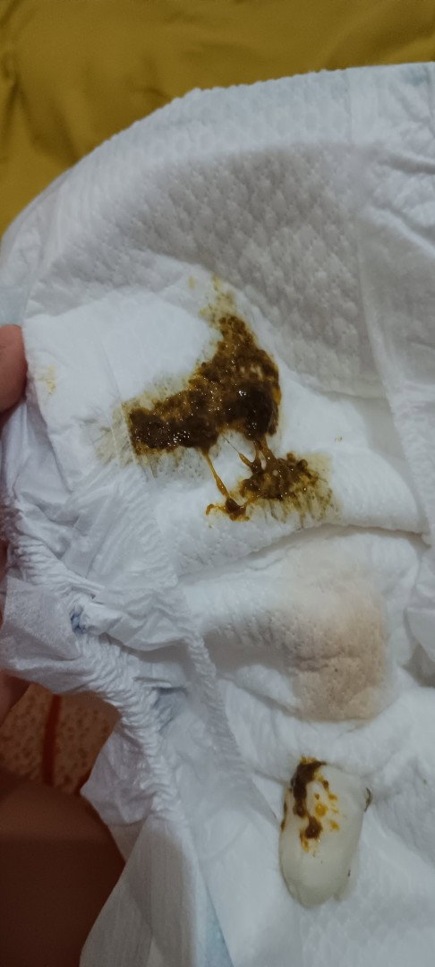 Tolong dijawab bun feses newborn 5 hari seperti ini normal/kenapa bun? New mom masih bingung sekali