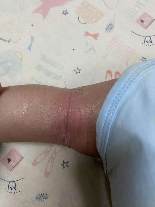 ผิวลอก เเละเเดง