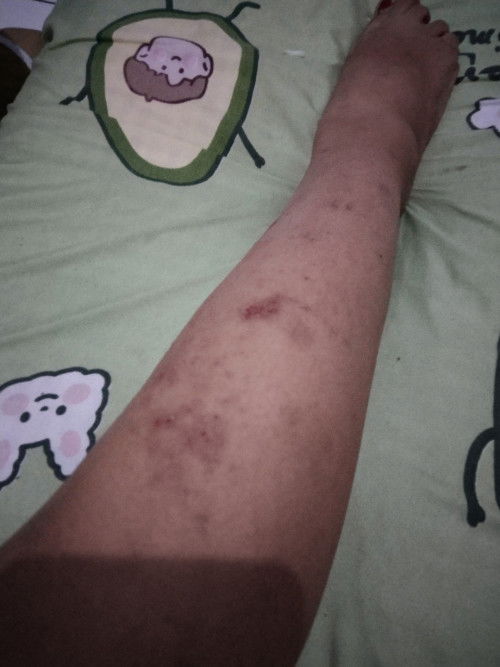 Gatal pada seluruh badan.
Ada gak bunda² disini yg sama kaya aku, gatal bgt sluruh badan