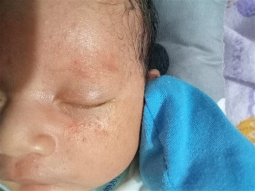 Bintik2 pada bayi
