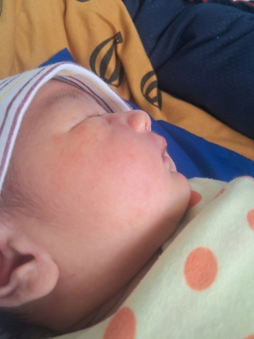 Ruam merah² di pipi karna apa yaa bund