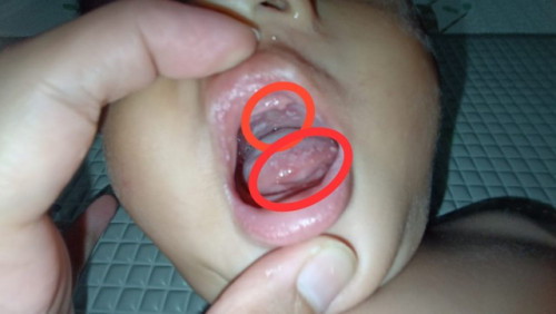 Ada ga yang anak yg pernah kaya di foto ini? Ujung lidah sama langit-langit putih.. Pake obat apa ya