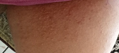 Gatal parah se badan badan