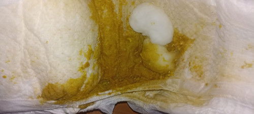 hello mga mi ask ko lang po if normal tong pooo ni baby, mix po sya, bonna and breastmilk. Parang