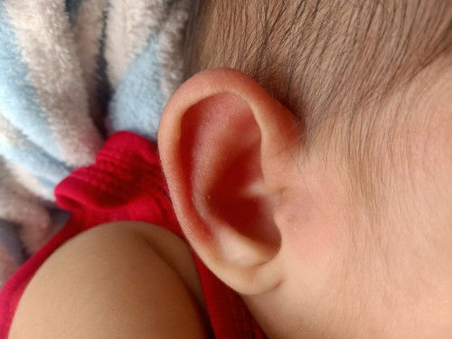 ผื่นแดงที่หู