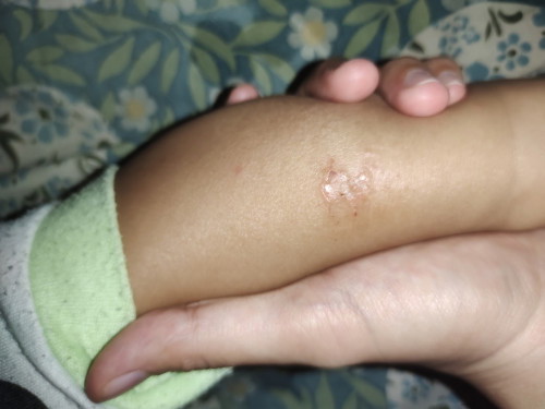 Kenapa ya anak saya umur 1 tahun kaki nya kering sampe luka2 karna di garuk terus ๐ฅบ๐ฅบ๐ฅบ