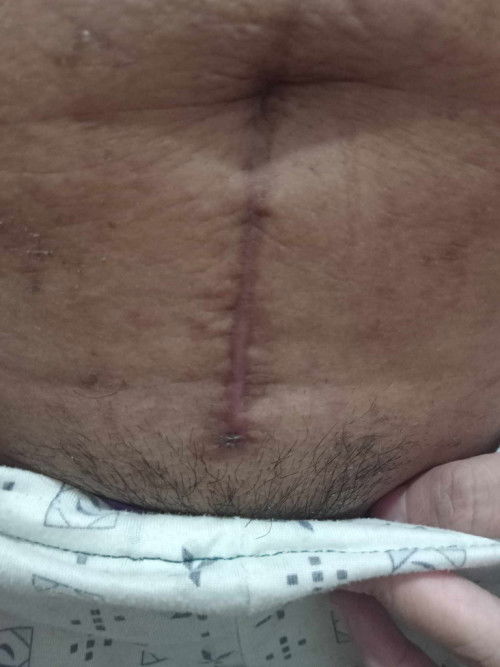 Cs mom 2 months postpartum