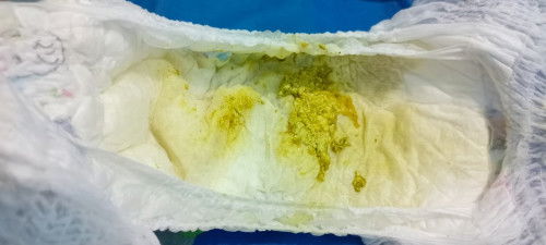 Permisi bun mau tanya masalah pup bayi , ini normal atau tidak ya ada lendir nya tapi sedikit