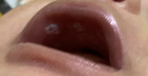 Sariawan bayi 1 bulan