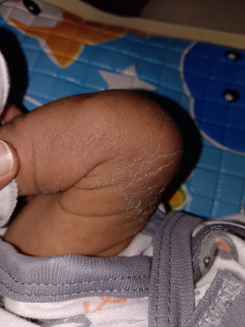 Kulit kering