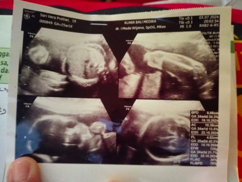 Bun ada yg sma gk kmrin aku USG tgl 3 juli seharusnya aku udh 25w tpi mlh masih 24w trus tgl 18 juli