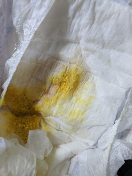 Baby's poop mcm ada darah. Or bukan?