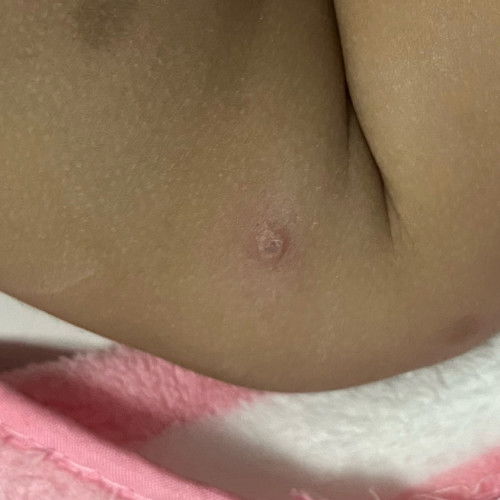 ตุ่มใหญ่ๆแดงๆแบบนี้คือโดนอะไรกัดคะมันหลายทีมาก