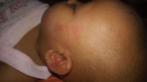 Gatal di wajah bayi