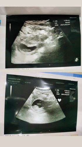 ทีมกุมภาหายแพ้ท้องกันยังค่ะ บ้านนี้หายแพ้ท้องแล้ว ดีใจมากๆ 🤰🏻