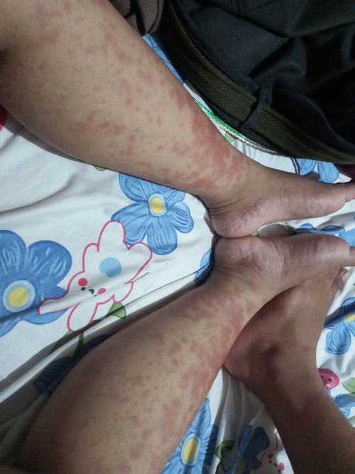 kehamilan 38 week, kena eksim