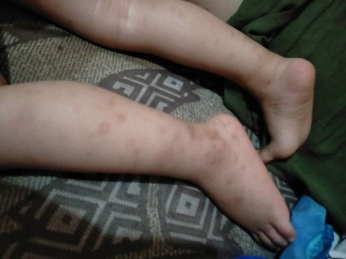 mau tanya dong yang punya pengalan penyakit kulit begini obatnya kira² apa ya sudah lama bgt gateljg