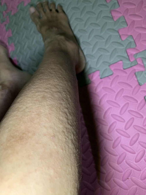 gatal alergi sejak hamil