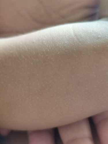 Ano po kayang tawag s mga puti puting maliliit s balat ng toddler ko? Normal po ba ito